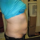 23 June pre op picture side 2