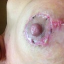 Day 23 - First indication of body rejecting dissolvable suture.