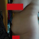 Side, Day of Surgery