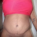 7 months post tt