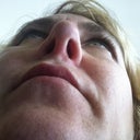 This is what my nose looks like today. Right side is collapsed, left has my ear cartilage in it.