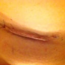 left incision. Do you think the stitch is dissolve-able?