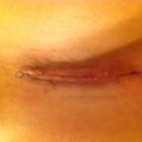 right incision is a little more tender. The white spots are dead flaky skin sorry