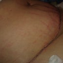 2-dpo trying to take a side view while laying down. Swelling was major here (I better be flatter than this!  lol)