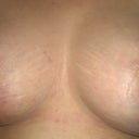 8-dpo (lefty looks bigger than righty!) hoping it is the angle or one hasn't dropped! Definitely don't want 2 different size boobies!