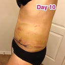 Ribs coming back from swelling