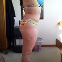 2 months P/O right side scar
