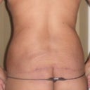 4.5 mos Post-Op