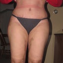 20 days post op