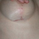 Hypertrophic scar in right breast which never resolved, even after applying medical-grade silicone sheets (Scar Fx)12 hours daily for 6 months two weeks post-op after 1st bilateral mastopexy.