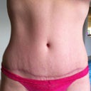 5 months po scar less red than previous month