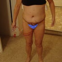 6 days Post op. I am holding my drains. They are normally pinned onto a compression garment. These came out at 8 days PO, for me.