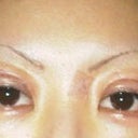 Day 13 post op, still very swollen, scar revision by left eye, under eye skin was lasered to tighten and help sunspots in upper cheek area
