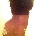 When i first took garment off this evening less swelling if u can tell lol