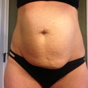 Front view, four days before surgery
