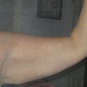Pre-op left batwing front view