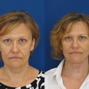 Here is my before and after - no make up.