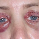 One day after surgery