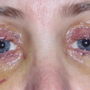 Six days after surgery