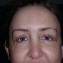 Four weeks after surgery