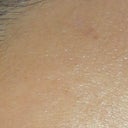 Mole Removal