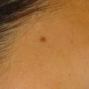 Mole Removal