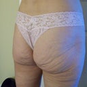 Before at 120lbs...need to put on "LB's" so the Doc has stuff to work with.