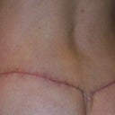 Healing & looking Great! It took what seems forever for the swelling to go down.