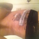 Side angle; 1 week post op.