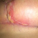 left spot of concern no longer black/purple