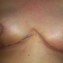 2 weeks post op