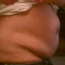 Other side before surgery
