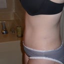 7 weeks post op