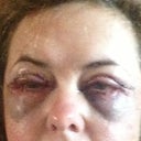 A few hours after surgery