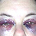 Day two a lot more swelling and bruising.