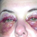 Day three. Really looking bad. The chemical peel under eyes is really starting to look raw.