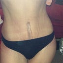 7 wks post op