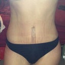 7 weeks post op