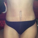 7 weeks post op