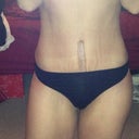 7 weeks post op
