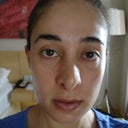 Day 7 post-op after having the splint removed