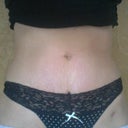 4 weeks, Certain undies covers scar really well