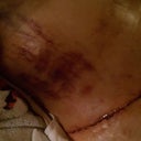 3 Days PO, OUCH