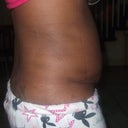 right side 12days post tt