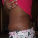 left side 12days post tt