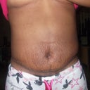 front view 12days post tt, with more swelling than before
