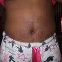 12days post tt, you can see how low my scar is. i also have some marks from the binder and my stretch marks are swollen