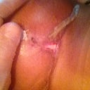 this is under my breast,when i fell,i busted my incision open