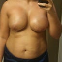 1 week post-op