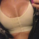 1st day post op pic. They are riding super high rite now